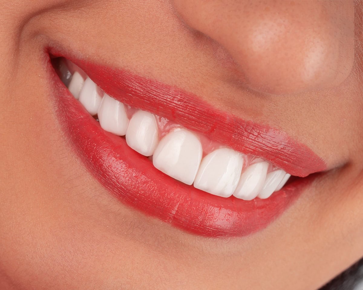 Blanqueamiento dental