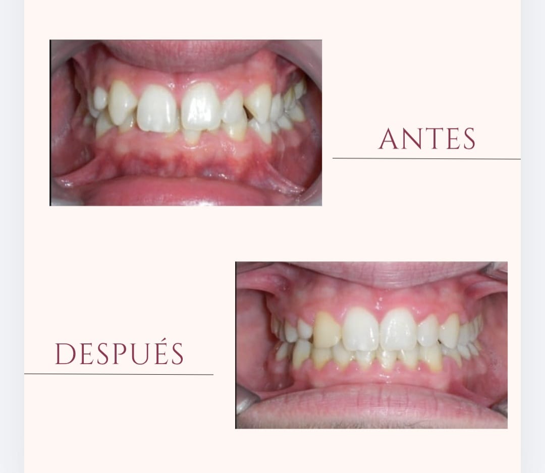 Brackets metálicos y estéticos