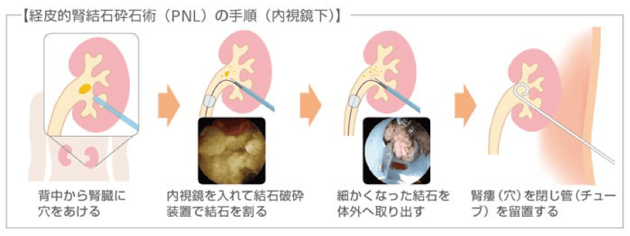 経皮的腎砕石術（PNL）の手順図解