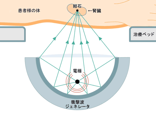 体外衝撃波結石破砕術（ESWL）の図解
