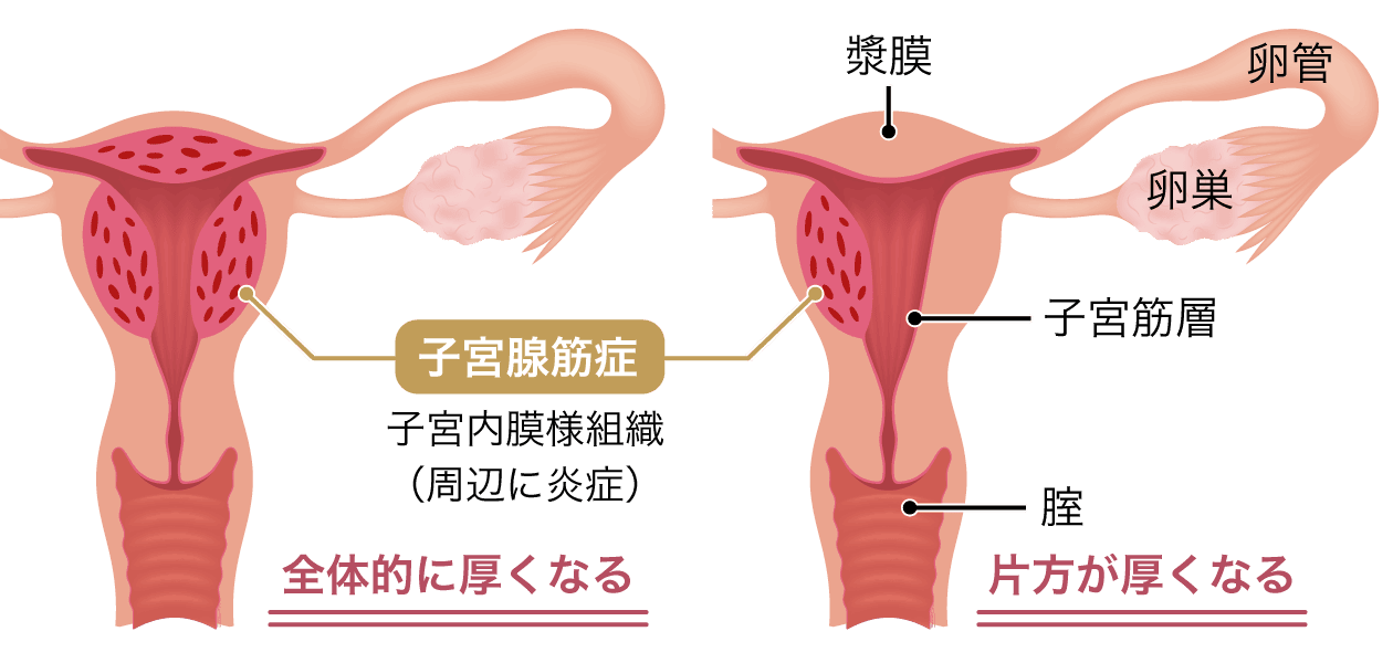 子宮腺筋症の説明