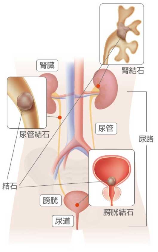 腎尿結石センターで治療が行える箇所