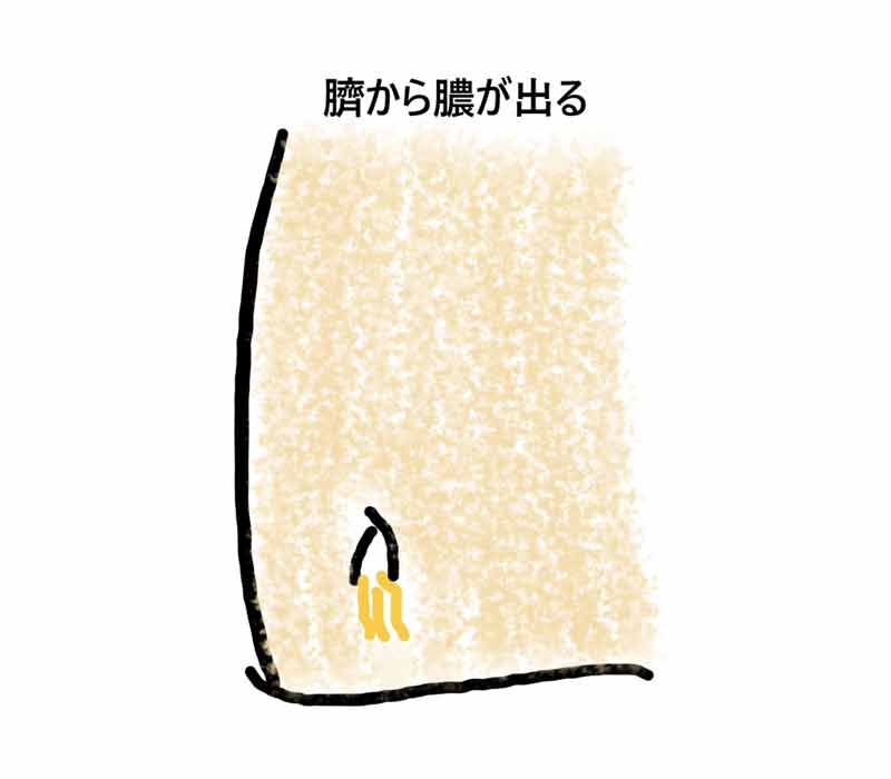 臍周囲の激しい痛み