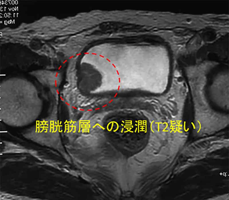 MRI検査膀胱筋層まで浸潤(T2)画像