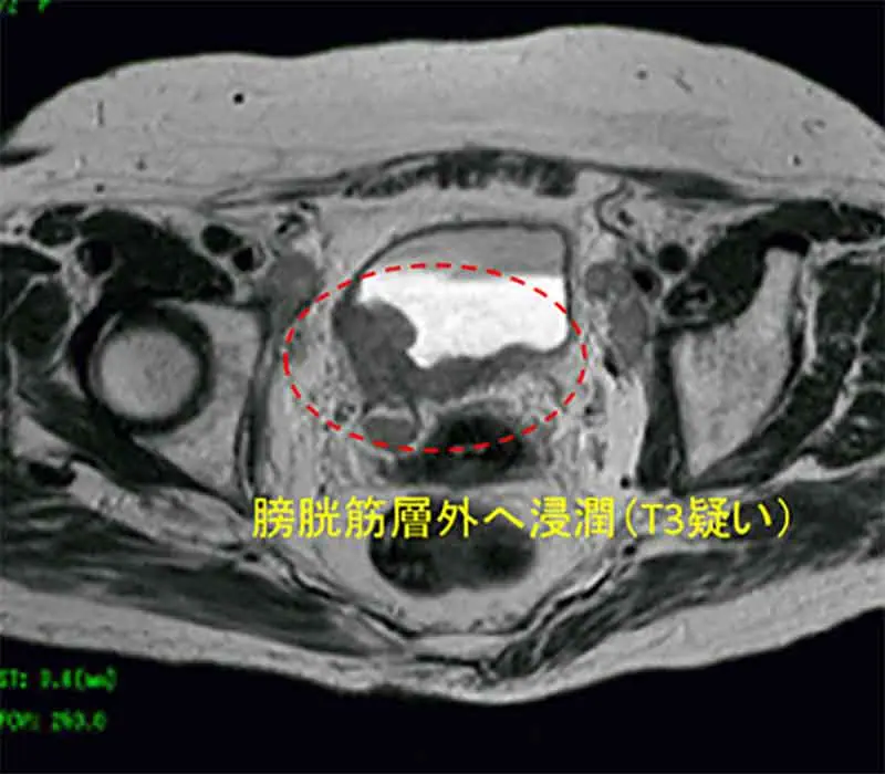 MRI検査膀胱周囲脂肪組織まで浸潤(T3)画像