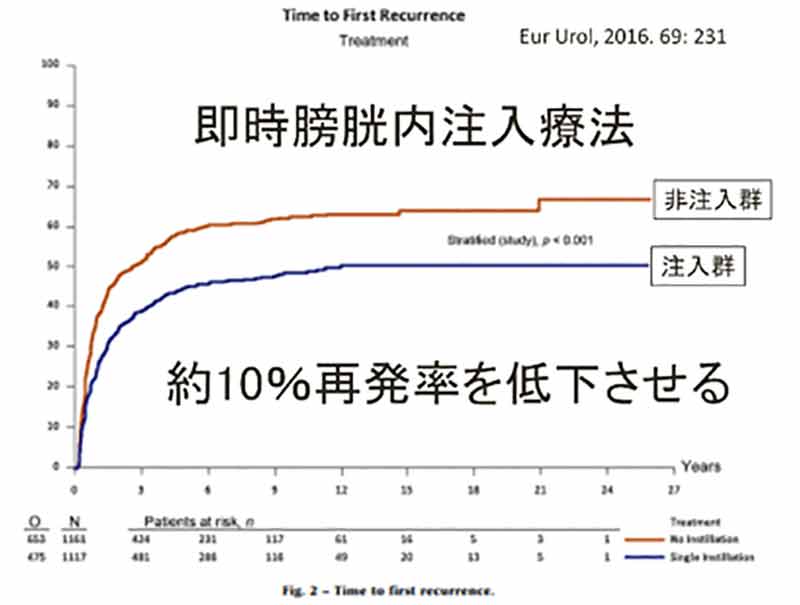 即時膀胱内注入療法