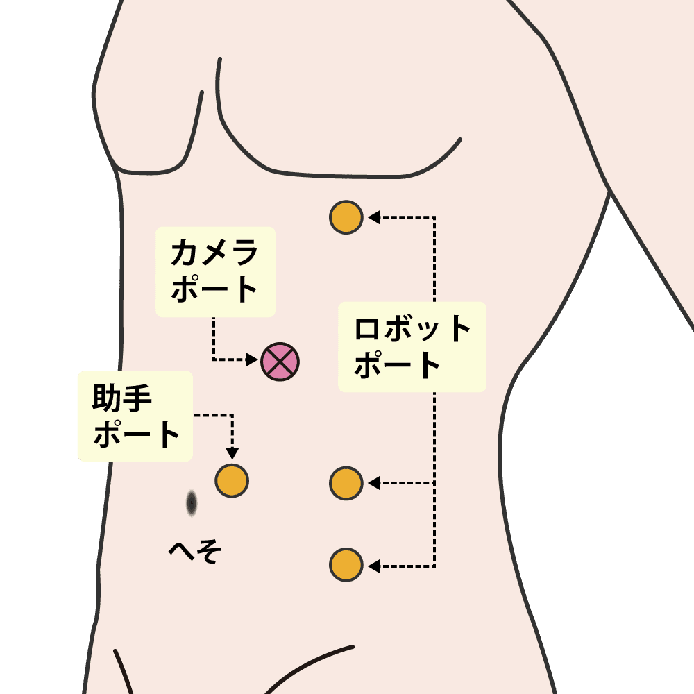 左ロボット腎部分切除術(腹腔内アプローチ)