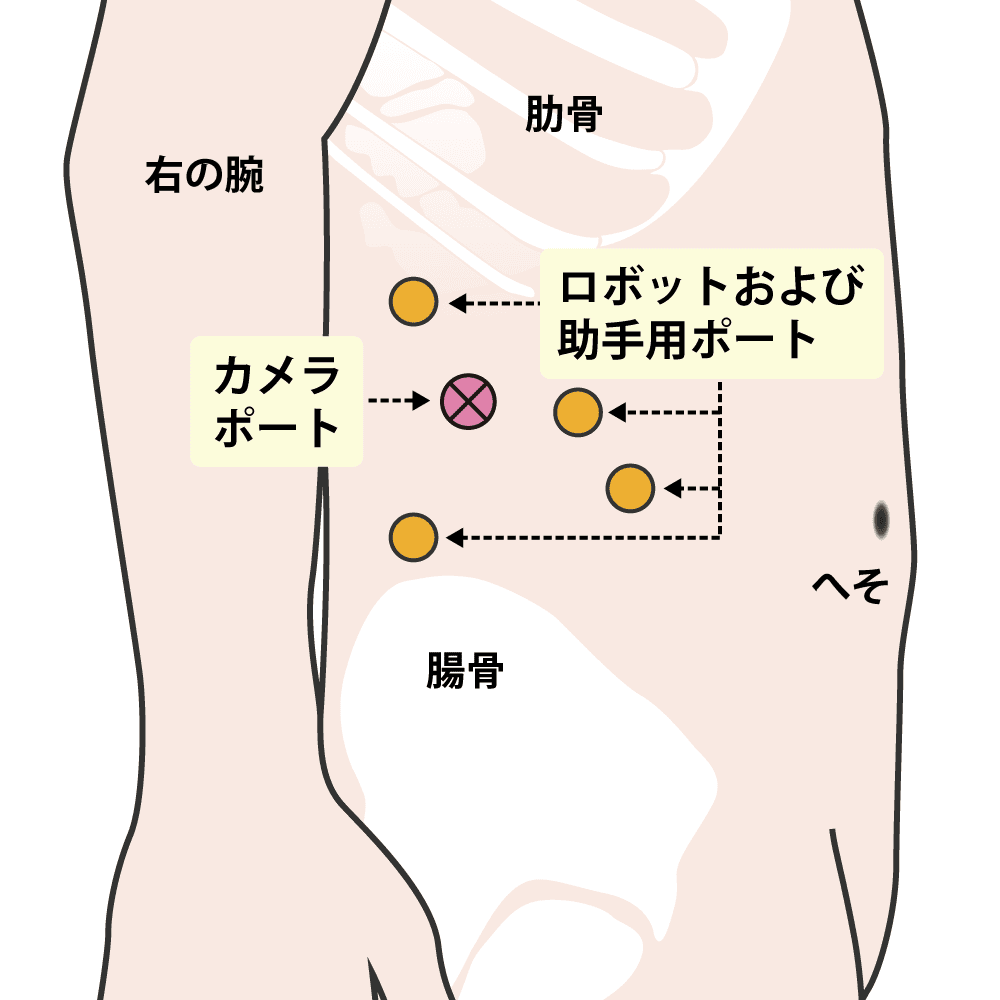 右ロボット腎部分切除術(後腹膜アプローチ)