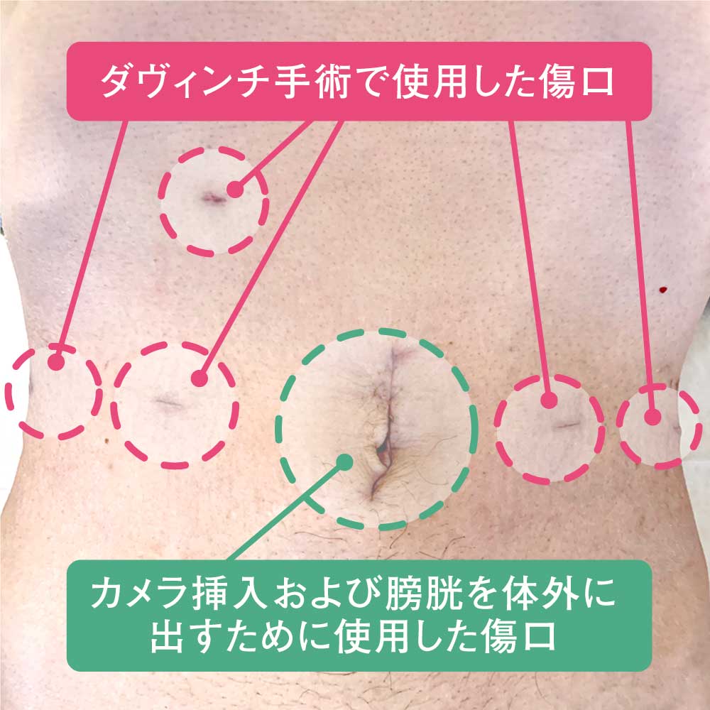 左)ロボット支援膀胱全摘術+代用膀胱造設術