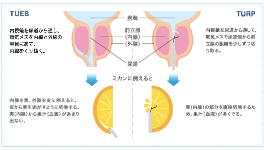 TUEBをみかんに例えると