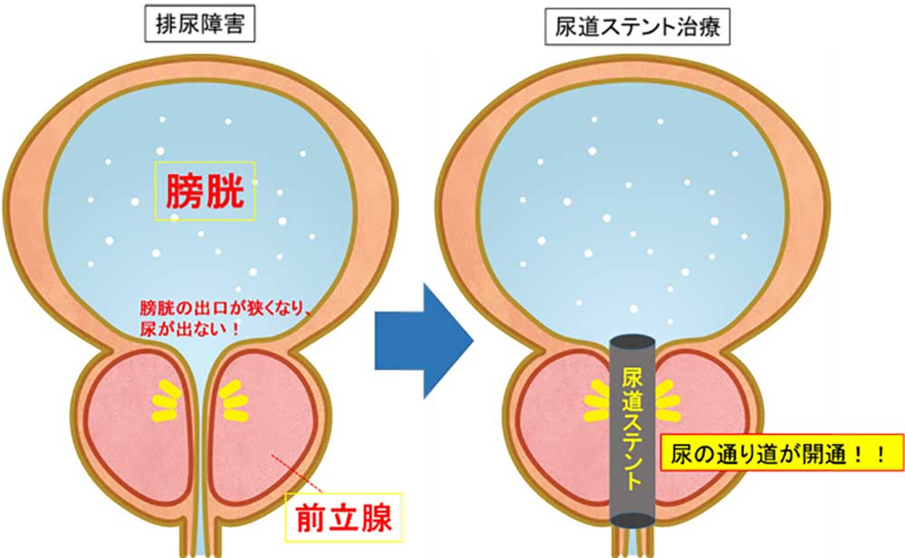 尿道ステントの図解説明