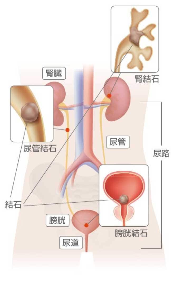 尿路結成の疾患箇所