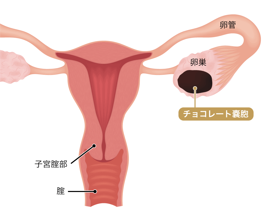 チョコレート嚢胞とは