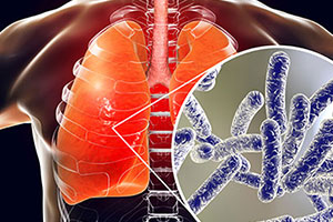 Legionella