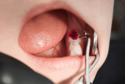 Broken Dental Fillings: What You Need to Know