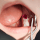 Broken Dental Fillings: What You Need to Know