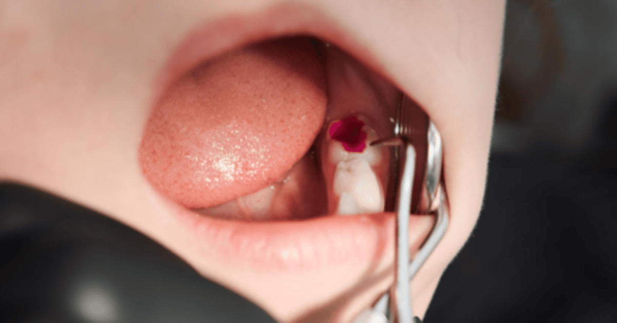 Broken Dental Fillings: What You Need to Know