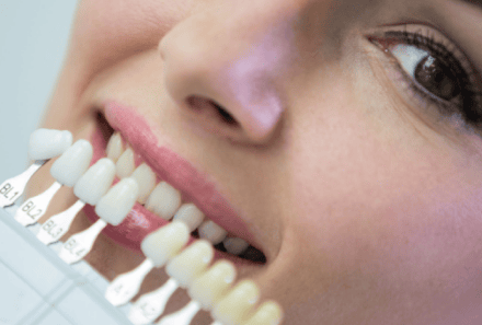 Veneers for Front Teeth Gap: A Simple Way to Transform Your Smile