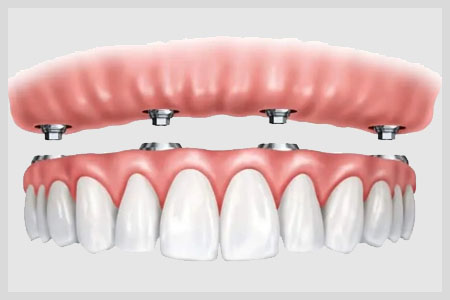 Veneers Cost_images - blyss-dental-veneers-cost-porcelain