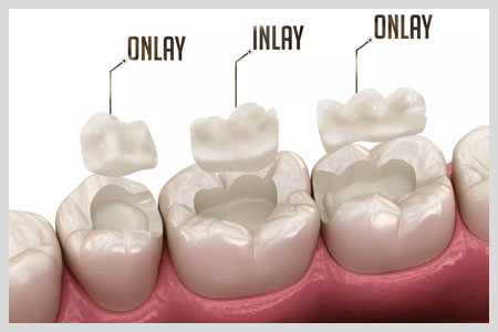 Veneers Cost_images - blyss-dental-veneers-cost-porcelain