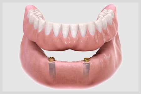 Veneers Cost_images - blyss-dental-veneers-cost-porcelain