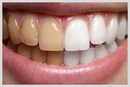 Teeth Whitening Services for Special Occasions