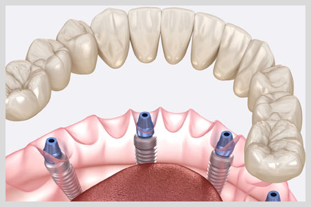 Teeth in a Day All on 4 Implants