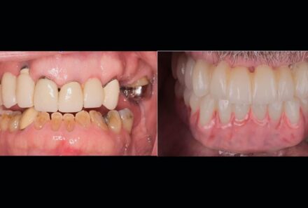 Full Mouth Dental Restoration: A Lifesaving Treatment for Oral Health