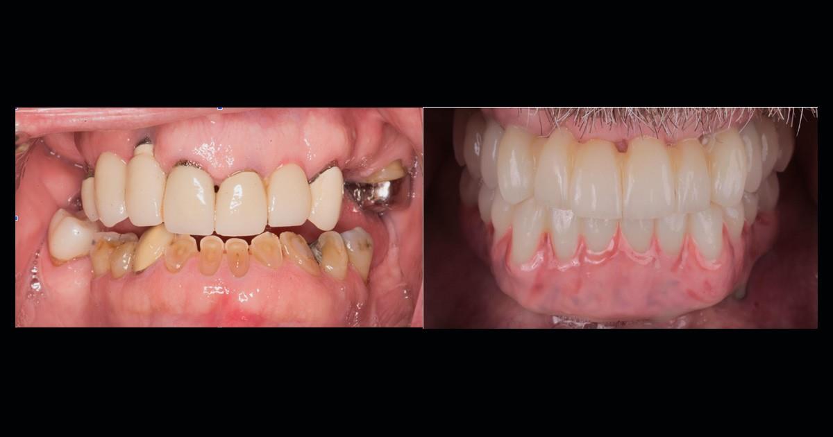 Full Mouth Dental Restoration: A Lifesaving Treatment for Oral Health