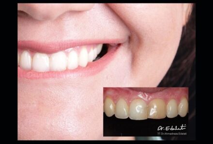 Teeth Whitening Services for Special Occasions: Smile with Confidence