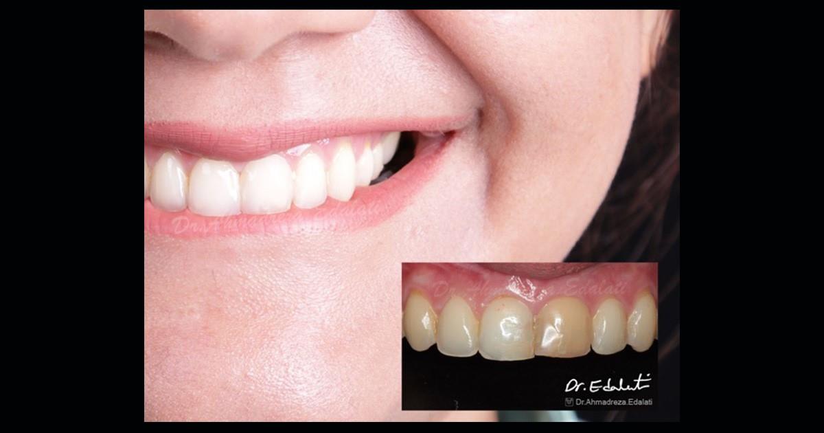 Teeth Whitening Services for Special Occasions: Smile with Confidence