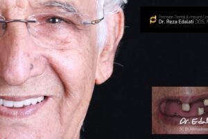 What You Need to Know About Full Mouth Rehabilitation and its Cost?