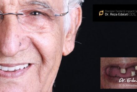 What You Need to Know About Full Mouth Rehabilitation and its Cost?