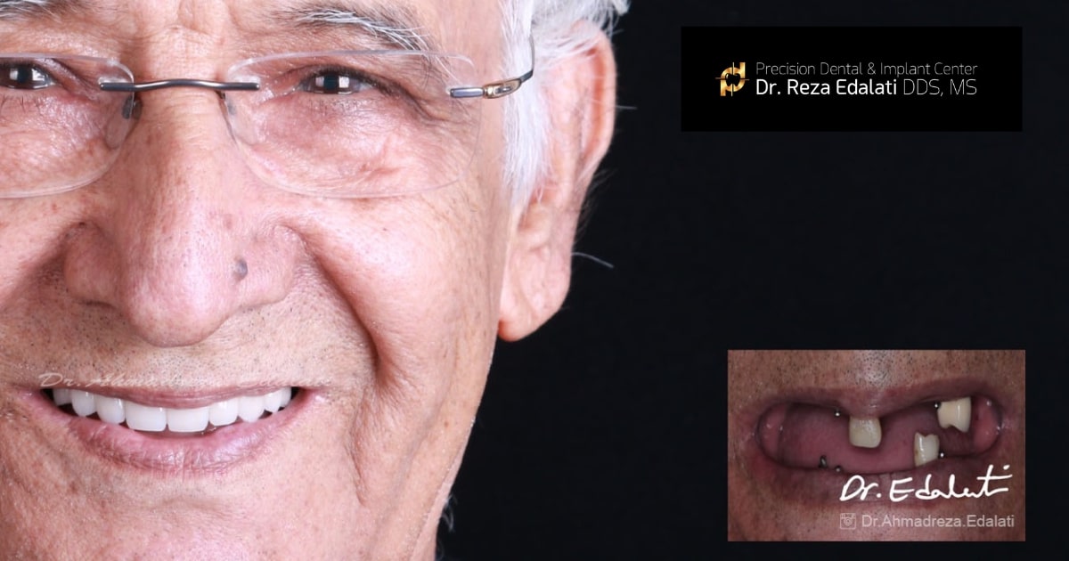 What You Need to Know About Full Mouth Rehabilitation and its Cost?