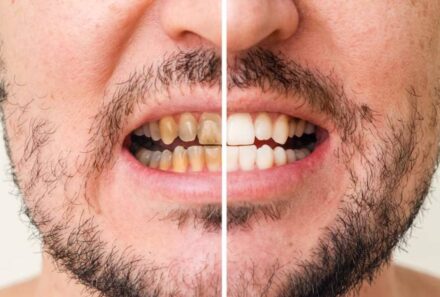 What Are the Benefits of Getting Full Mouth Dental Implants?