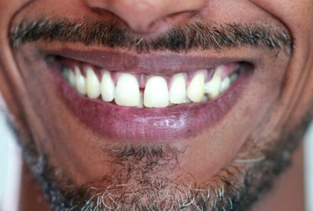 Veneers vs. Implants: What is the Best Option?