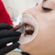 Who Needs Full Mouth Rehabilitation? A Detailed Guide!