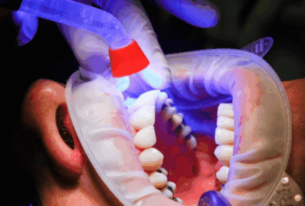 How Long Does Professional Teeth Whitening Last