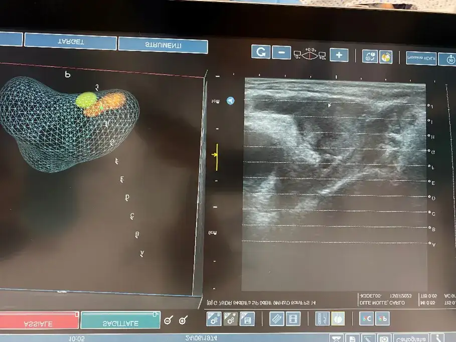 Chirurgia Echolaser cancro prostata