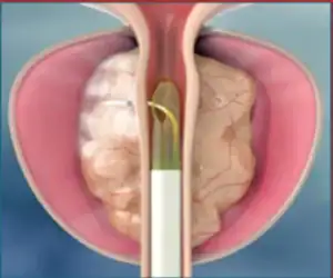 Ipertrofia Prostatica Benigna - Rezum Fase 2