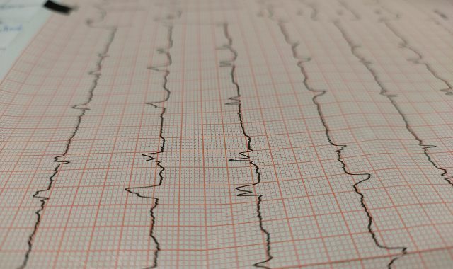 electrocardiogram, heart attack, tracing, cardiology, chest pain, heart attack, heart attack, heart attack, heart attack, heart attack, cardiology, chest pain