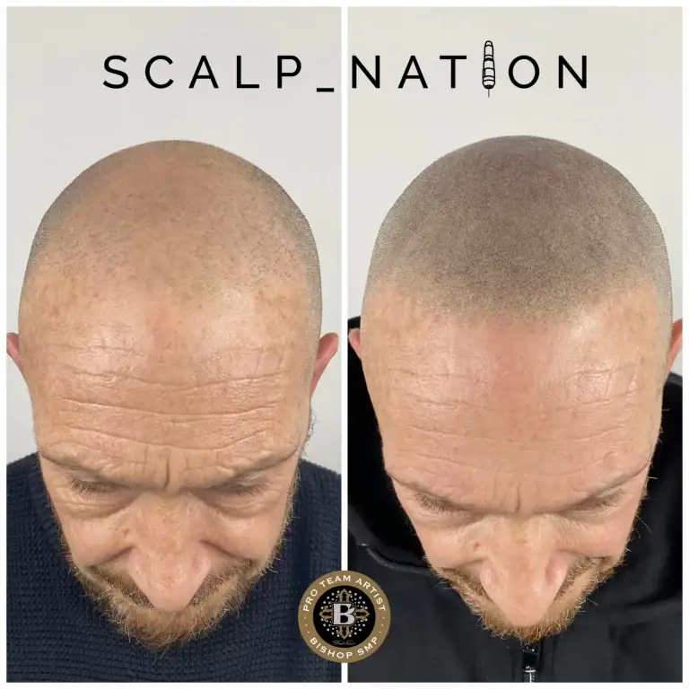 Scalp Micropigmentation Transformation Before And After