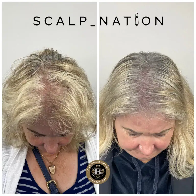 Scalp Micropigmentation Transformation Before And After