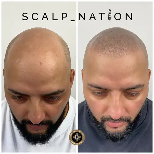 Scalp Micropigmentation Transformation Before And After