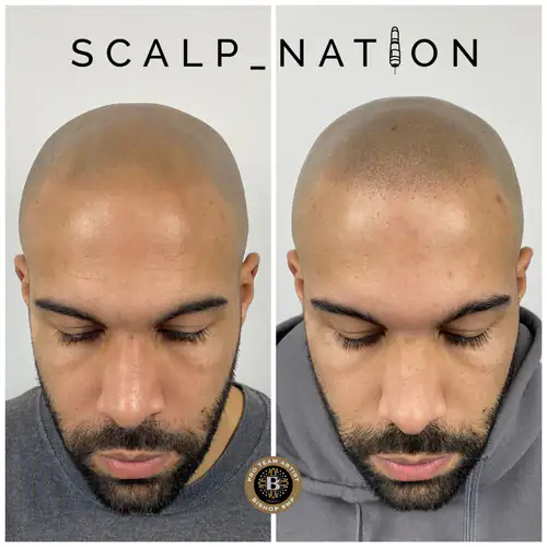 Scalp Micropigmentation Transformation Before And After