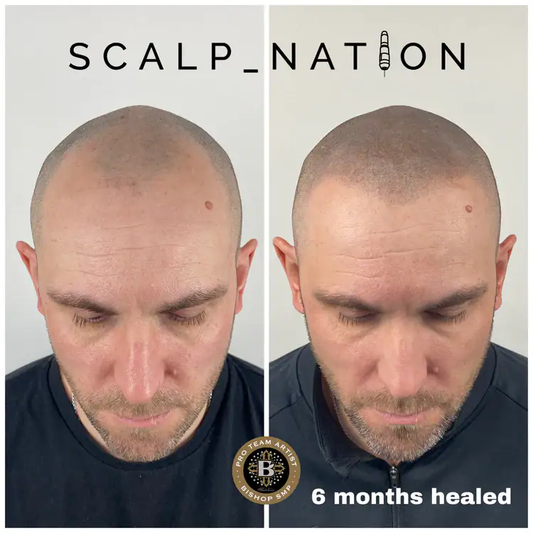 Scalp Micropigmentation Transformation Before And After