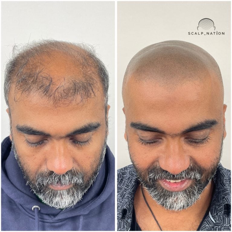 Scalp Micropigmentation Transformation Before And After
