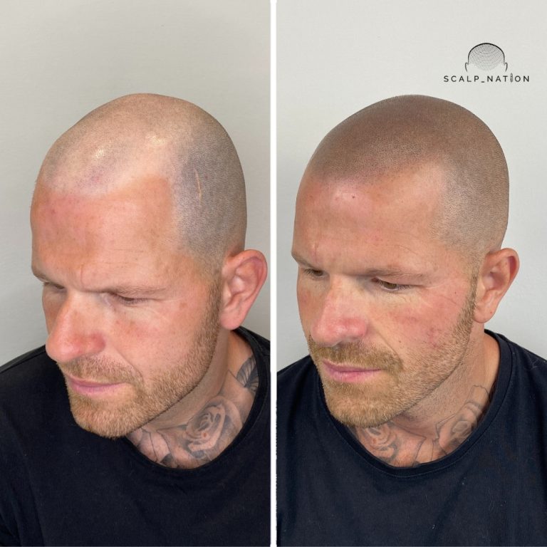Scalp Micropigmentation Transformation Before And After