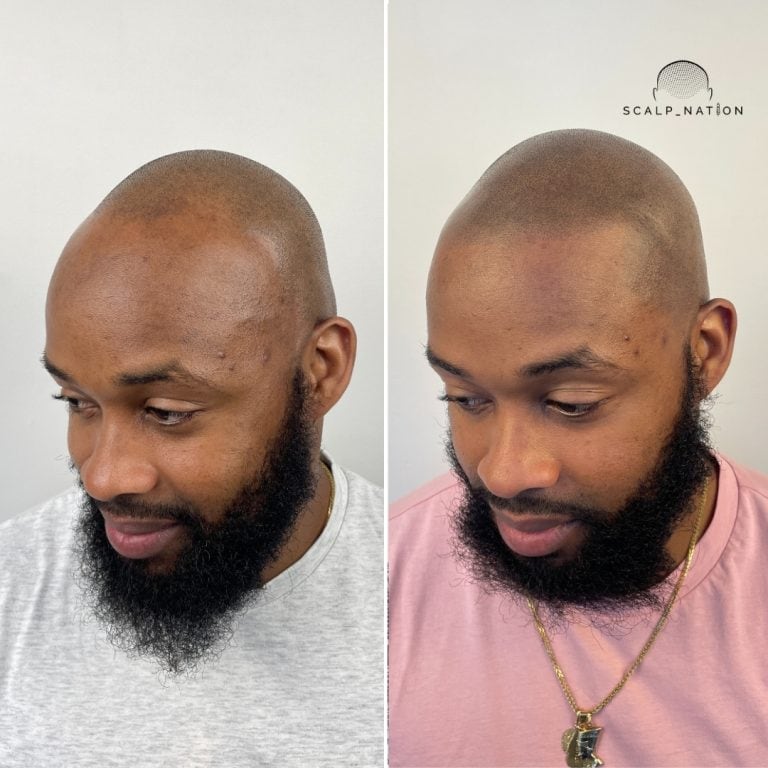 Scalp Micropigmentation Transformation Before And After