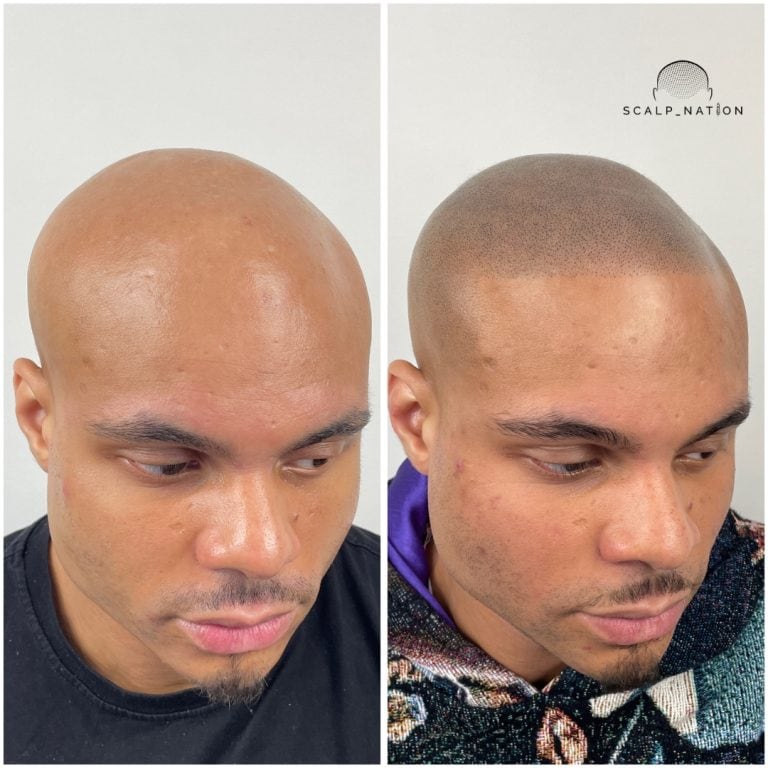 Scalp Micropigmentation Transformation Before And After